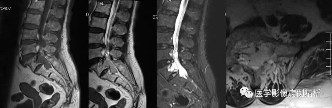 海绵状血管瘤在mri中的影像表现,骶骨处影像显示有血管瘤