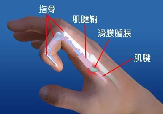 拇指狭窄性腱鞘炎鉴别诊断,狭窄性腱鞘炎自愈一般多久