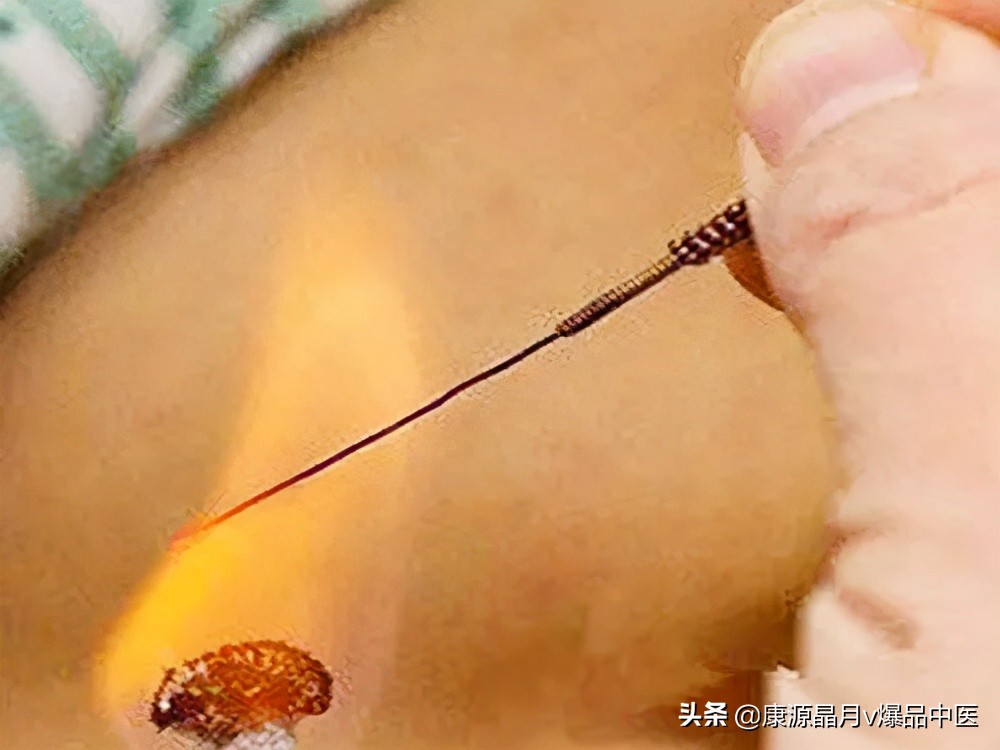 火针治疗颈椎多久有效果,火针治疗皮肤病多久一次