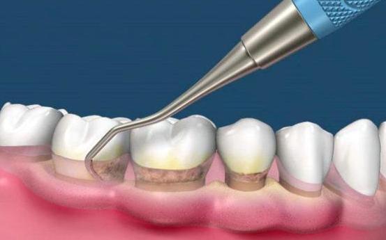 满口都是蛀牙很严重可以洗牙吗,蛀牙严重的牙齿都烂掉可以洗牙嘛
