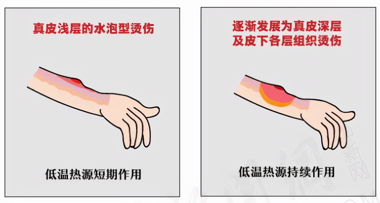 苏菲卫生巾发热烫伤,卫生巾治疗烫伤吗