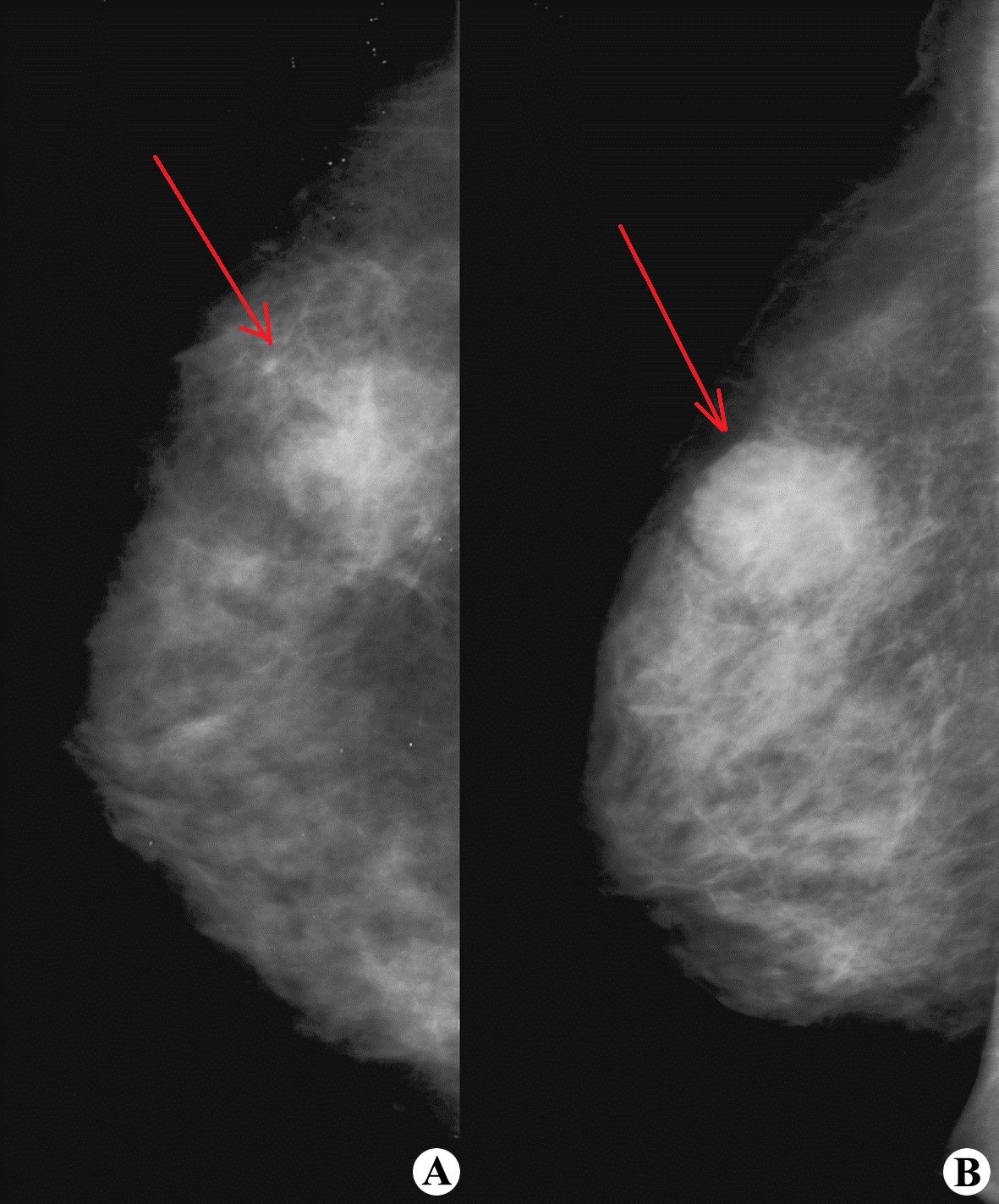 4个好习惯让你远离乳腺癌,多抚摸有助于预防乳腺癌么