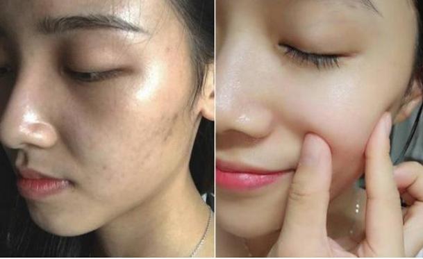 了不起的美白祛斑霜,了不起的国货去除痘印