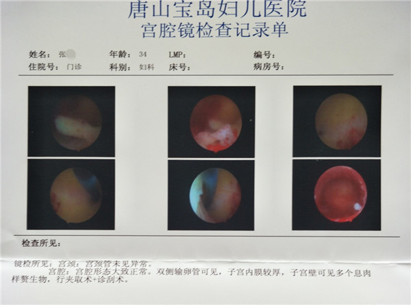 清除“息肉”障碍不孕患者在河北唐山宝岛妇儿医院求子成功