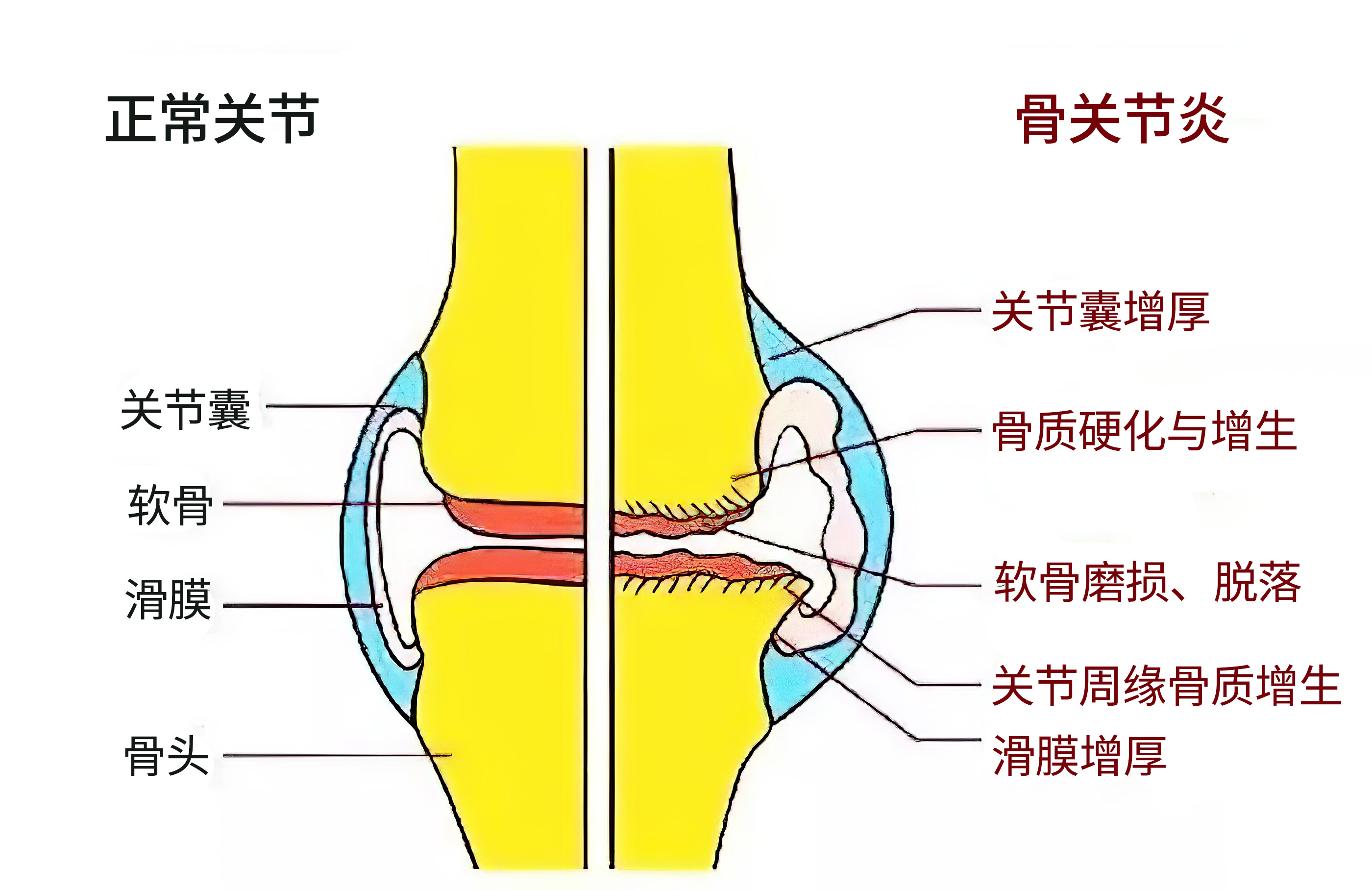 膝骨关节炎吃哪种氨糖好,中老年女性膝盖疼痛吃氨糖有用吗