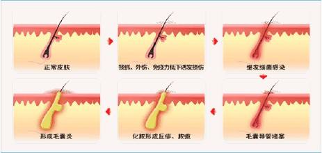 头皮长小小的脓包又痛又痒怎么办,头皮上出现脓包特别痒怎么办