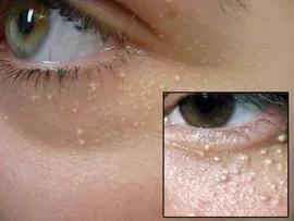 眼睛周围长了脂肪粒怎样才能去除,小孩眼睛周围长脂肪粒是什么原因