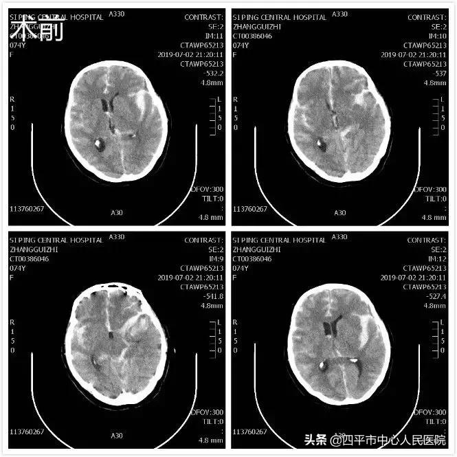 精准排雷再现新高—神经外科在6月份成功救治6例颅内动脉瘤患者