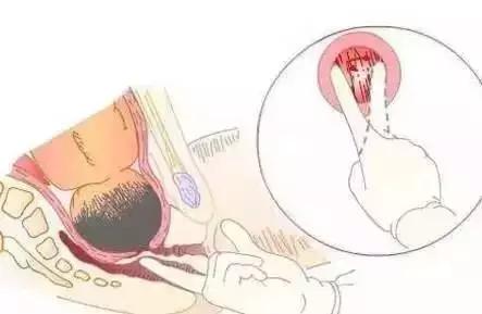 顺产开十指是十根手指宽吗,顺产开十指要侧切吗