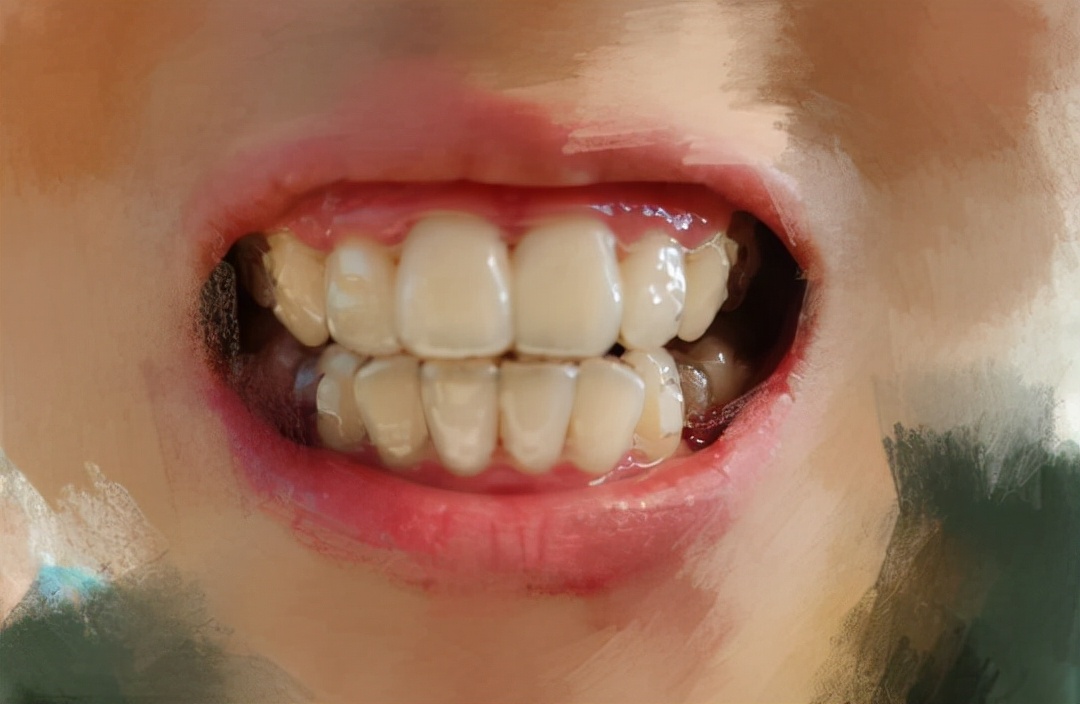 杭州牙齿龅牙矫正,牙齿矫正记录隐适美