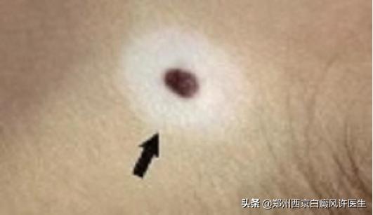 白癜风晕痣能彻底治好吗,晕痣白癜风好转的现象