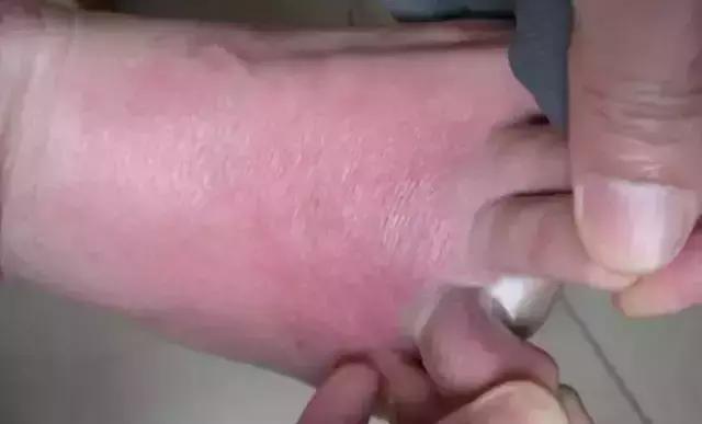 脚好流汗臭还有脚气用什么偏方,怎么样治疗脚气水泡型偏方秘方