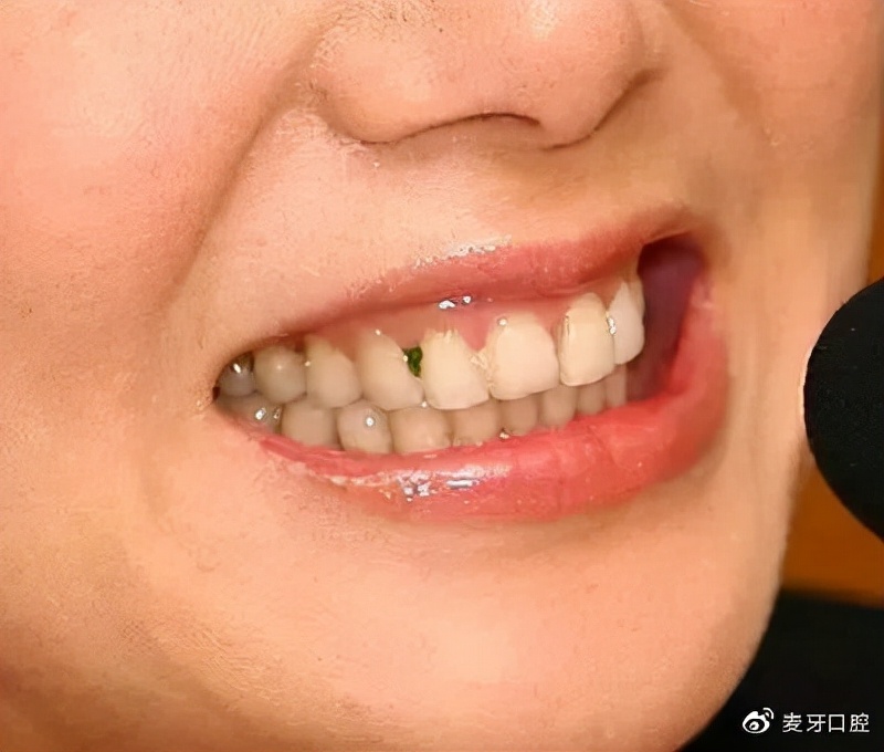 吃肉塞牙牙缝臭怎么办,总是塞牙牙缝臭