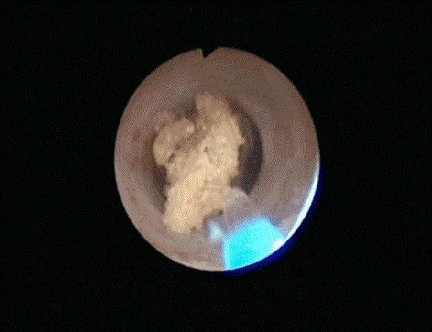 结石做微创手术全过程,十年前的结石终于手术了