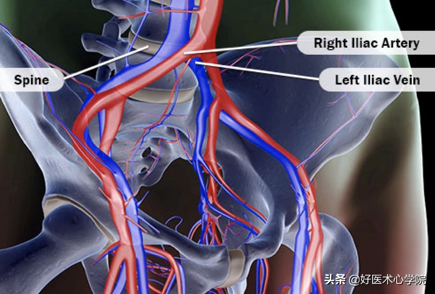 最常见的血栓类型是,最致命血栓视频