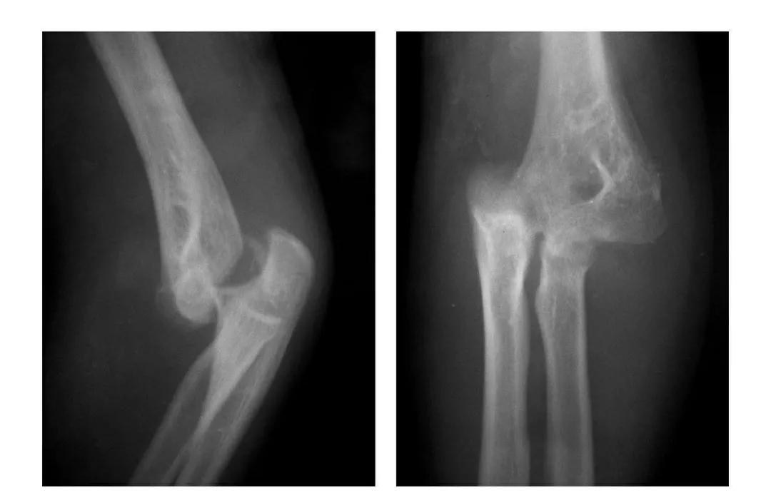 青少年肘部损伤最常见的是,肘部桡神经损伤的临床表现
