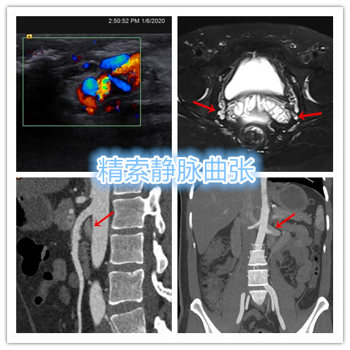 精索静脉曲张介入栓塞死路一条,精索曲张介入栓塞
