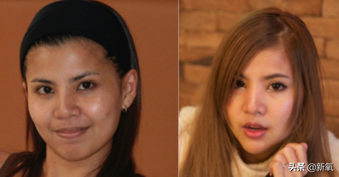 18岁土肥圆豪掷800万全身整形，鼻子6次大整假体穿出，效果却超美