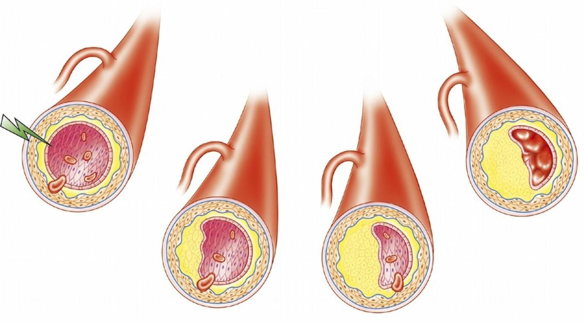 得了冠心病会不会心脏不舒服,冠心病搭支架后能活到正常寿命吗