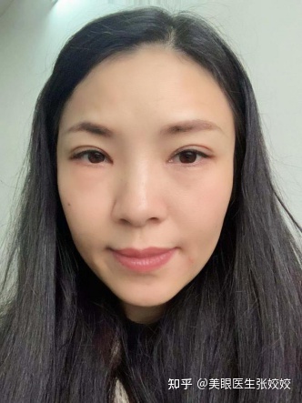 割双眼皮会影响运势吗,40岁割双眼皮效果图