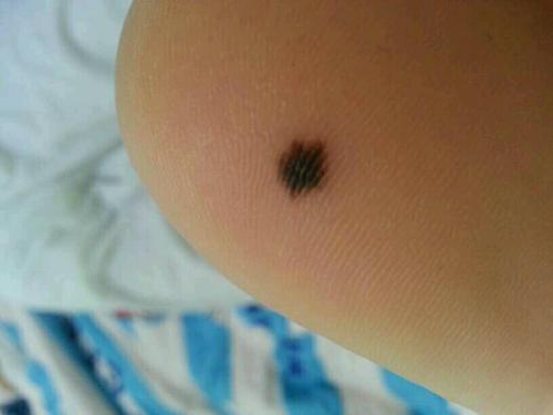 皮肤上长了一个痣怎么办,皮肤上长痣是什么癌