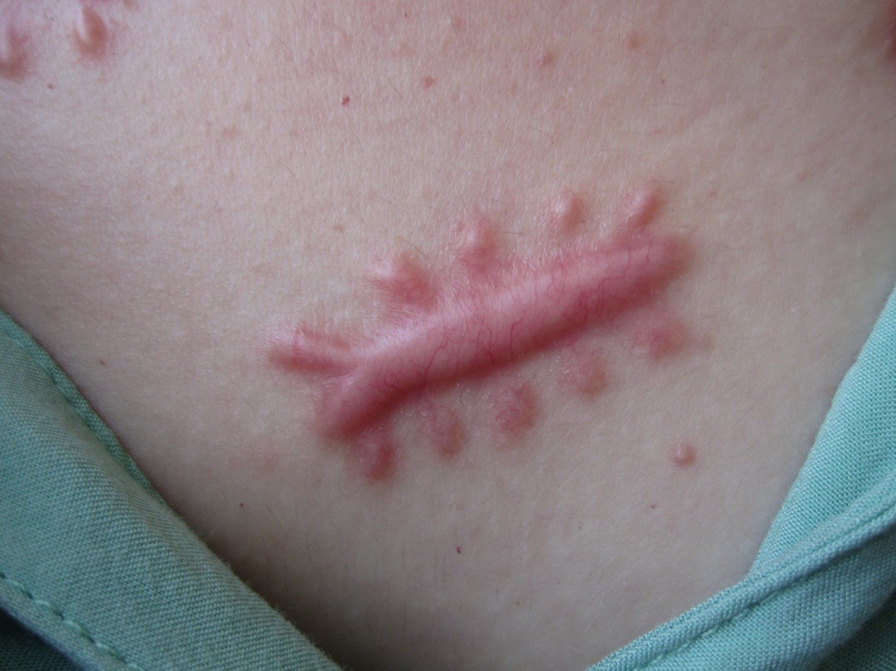 祛除疤痕增生最有效的方法是什么？