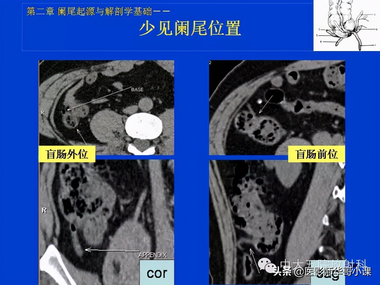 阑尾炎课件,阑尾炎的超声课件
