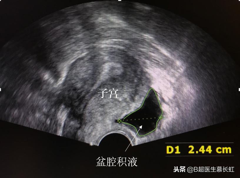 盆腔积液会导致肚子痛嘛,盆腔积液会引起肚子疼腰不舒服吧