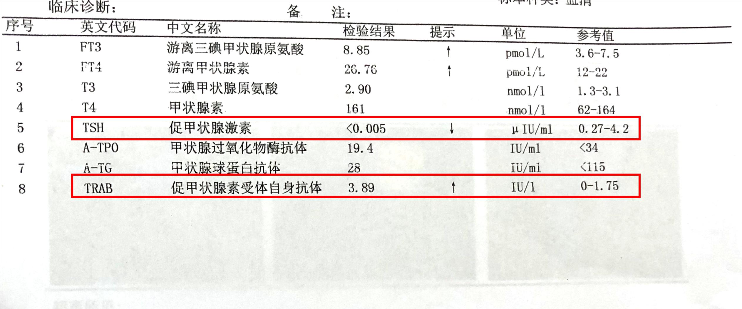 甲亢眼睛突真实案例,甲亢现状