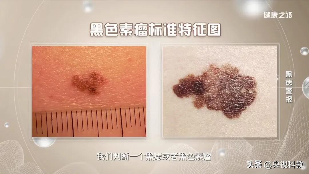 身上的黑痣有癌变的风险吗,身上长黑痣怎样防止恶变