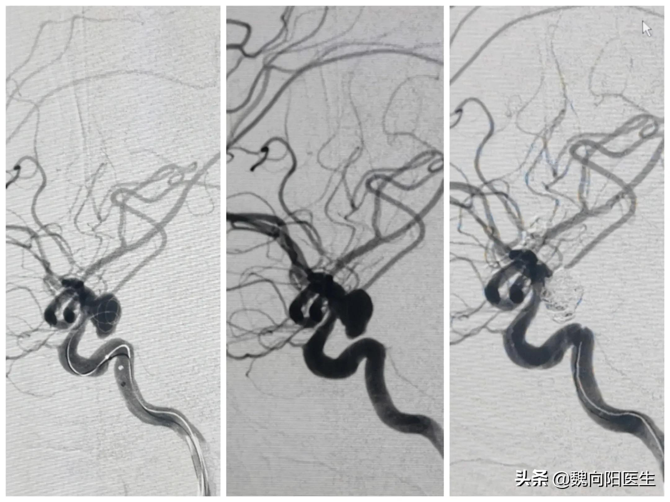 脑动脉瘤破裂后昏迷开颅,颅内动脉瘤破裂出血昏迷不醒
