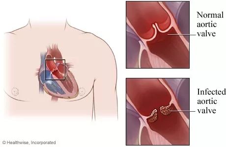 心脏的洞,心脏洞修补好还是封堵好