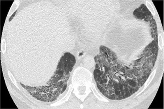 间质性肺疾病看病经验分享,分享肺腺癌临床实验的例子