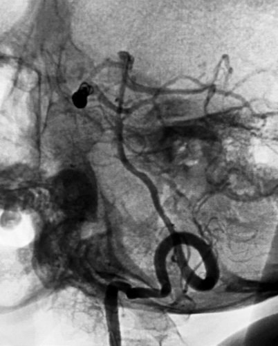 颅内巨大动脉瘤首选治疗技术,大脑中动脉动脉瘤闭塞的介入治疗