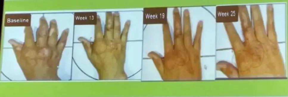 痛风全套,痛风治疗指南最新版