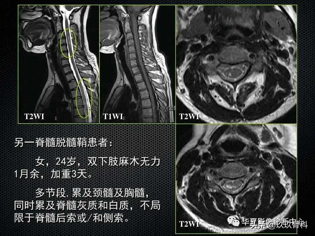 颈椎病脊髓变性mri表现,脊髓亚急性联合变性的诊断