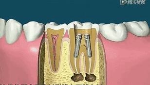 根管治疗第四步骤,根管治疗案例分享话术