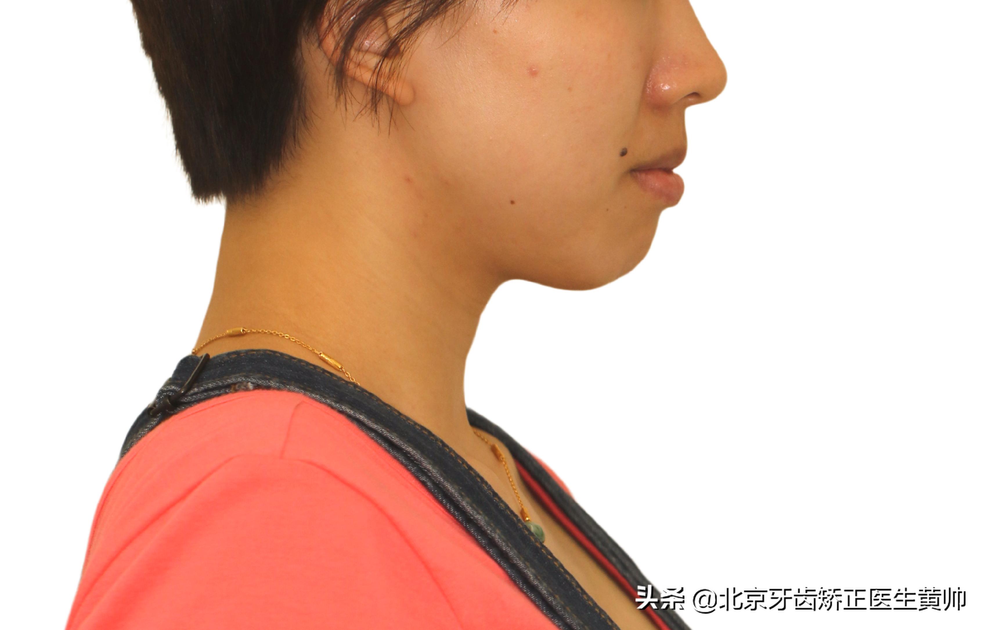 橡胶牙套矫正后脸型变化,戴过牙套的脸恢复了吗