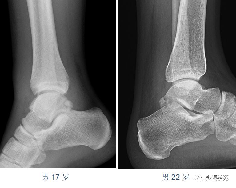 桡骨远端骨折引起尺骨变异,撕脱骨折一个月无明显骨痂形成