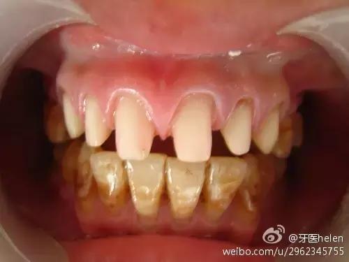 helen齿科黄璐,helen牙齿贴面