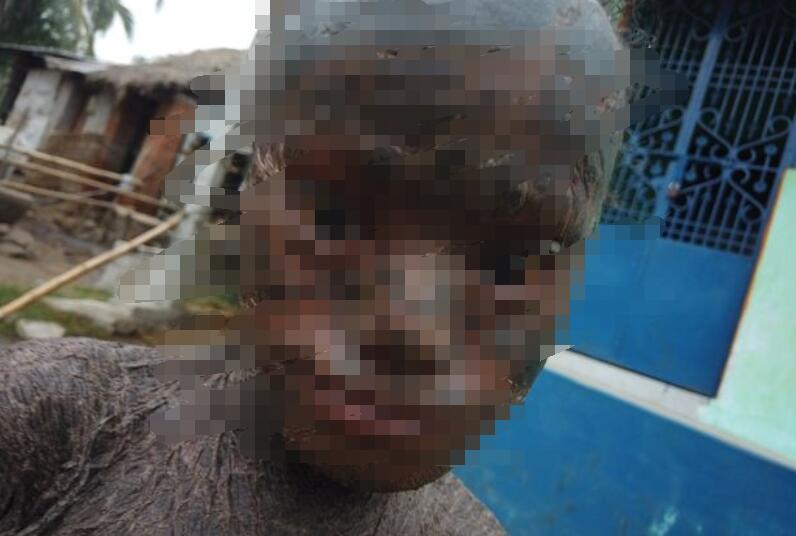 印度男孩患罕见皮肤病，每个月都会蜕皮，全身黢黑被当地称为人蛇