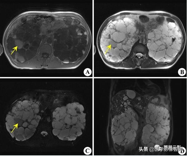 18种泌尿生殖系统常见疾病MR诊断总结