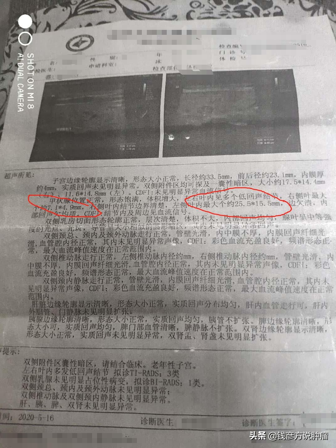 甲状腺结节3类有药吃能治好吗,甲状腺结节3类喝中药能治好么