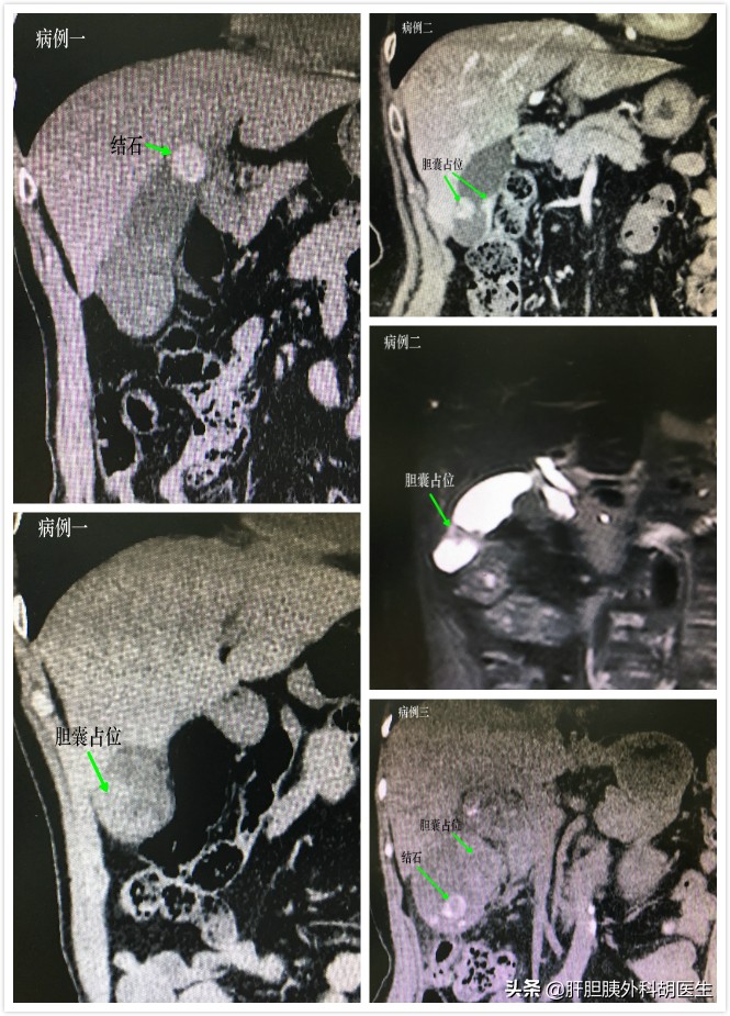 胆囊结石伴随胆囊息肉怎么办,胆囊息肉已经1.9厘米了会不会癌变