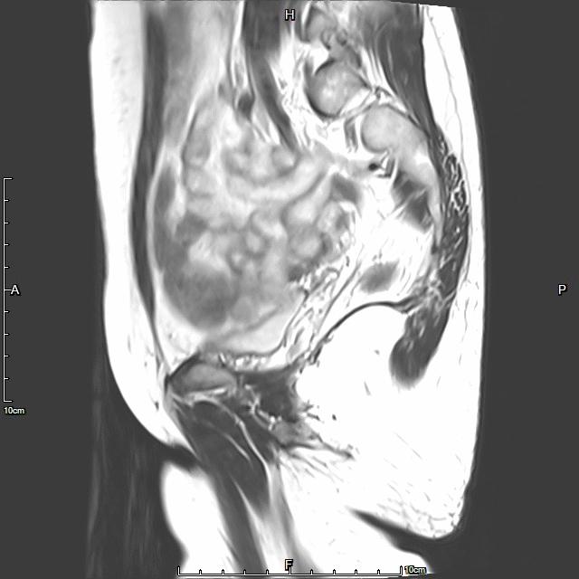 「不死的癌症」之克星——子宫腺肌症介入栓塞治疗