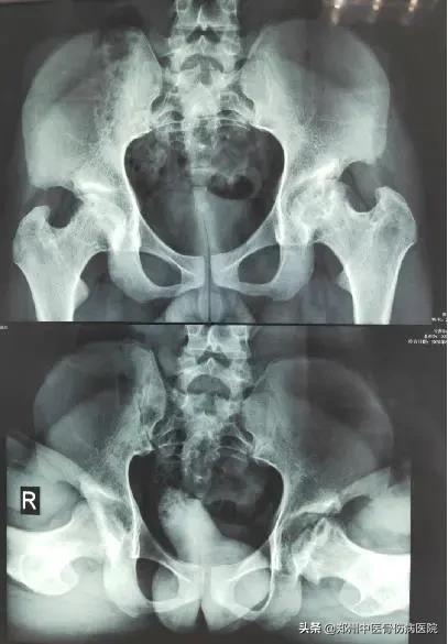 骨坏死中心疑难病例讨论:髋关节的剥脱性骨软骨炎的诊治