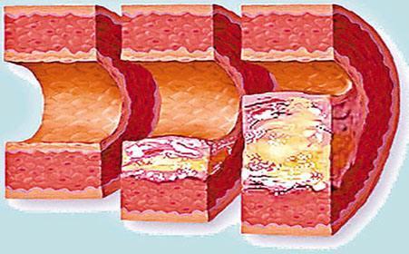 预防心脑血管吃什么食物最好,哪些食物可以清理血管垃圾