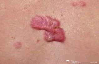 疤痕疙瘩用什么药可以软化疤痕,疤痕疙瘩是硬的