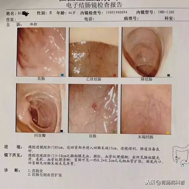 我做普通肠镜的经历及感受,年轻人做普通肠镜可以忍受吗