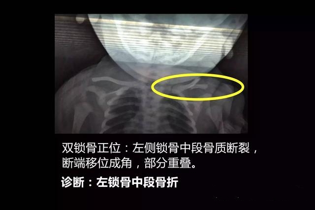 顺产锁骨骨折需要治疗吗,顺产锁骨骨折的宝宝日常怎么护理